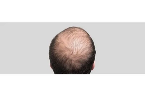 К чему снится залысина